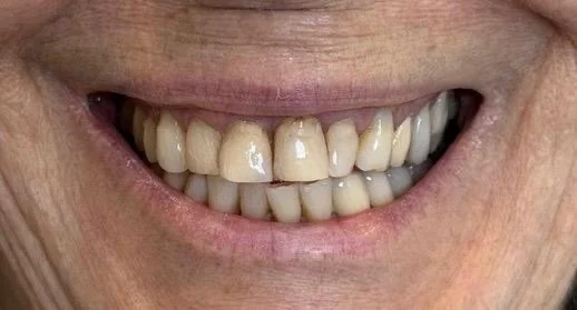 Antes do tratamento com facetas de porcelana