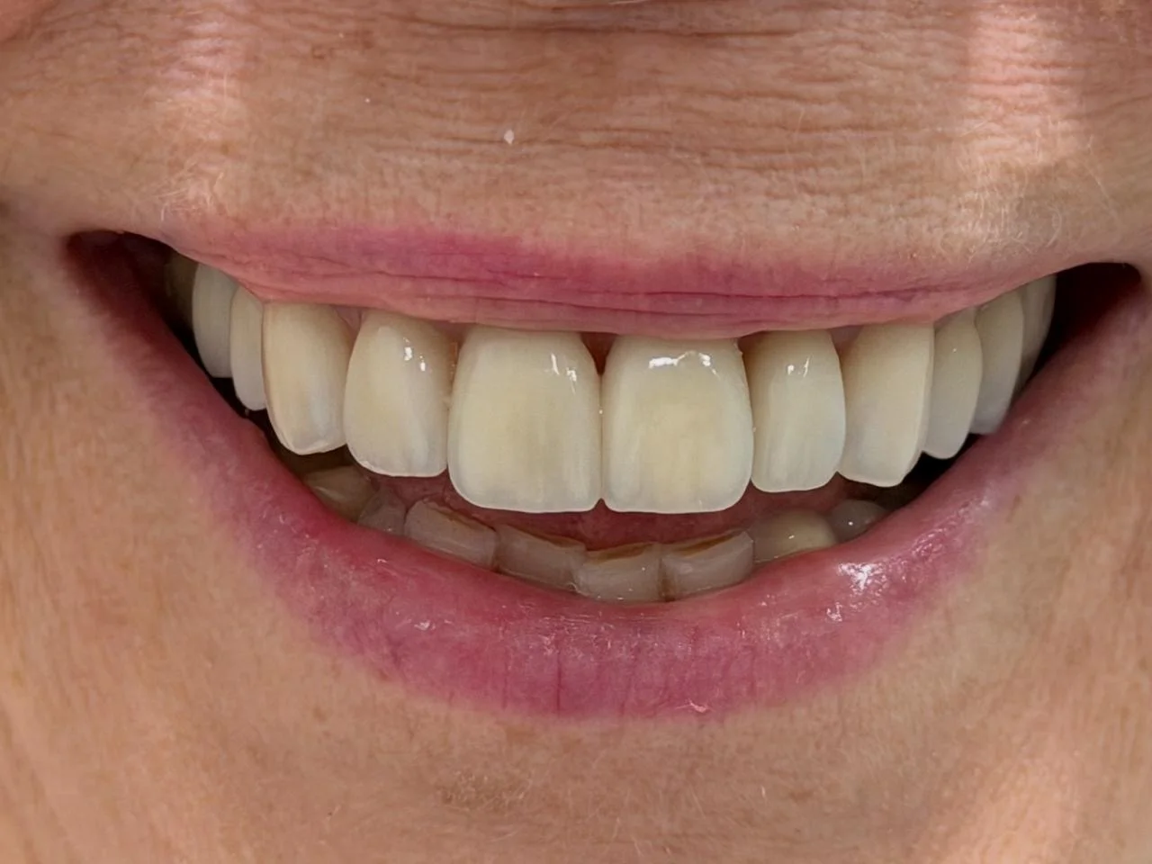 Depois do tratamento com facetas de porcelana